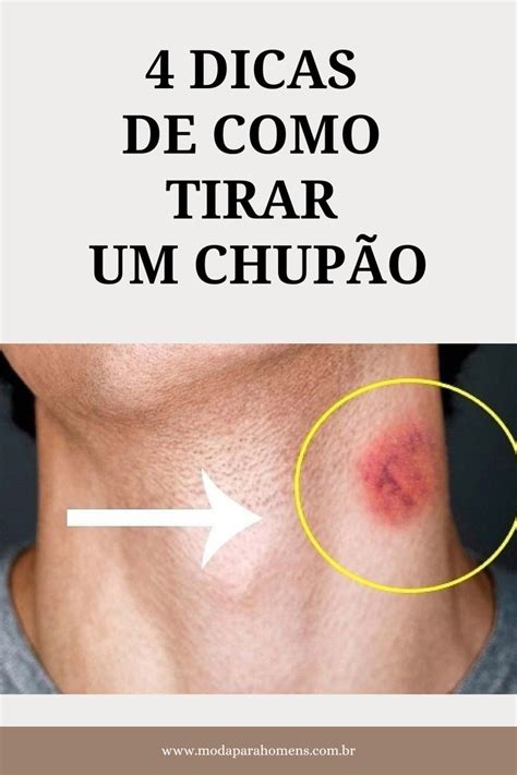 como titar chupao|15 truques fáceis de como tirar chupão do pescoço